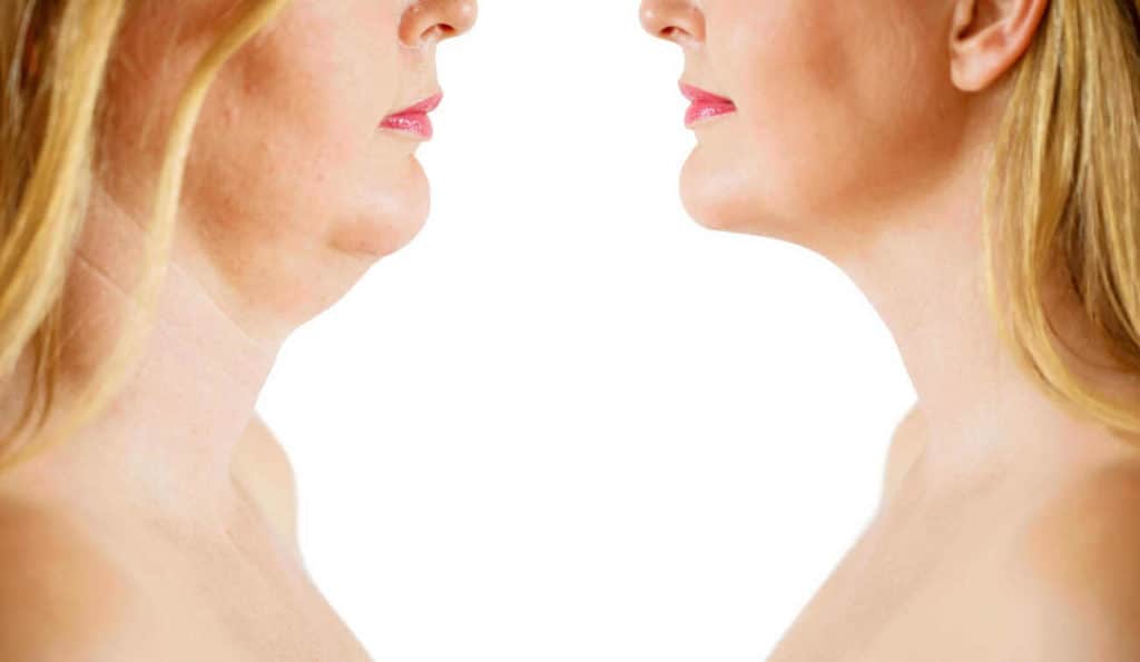 Double Chin treatment Melksham before and after results