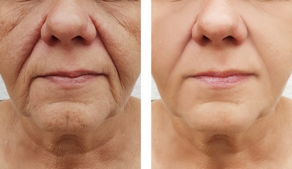 Learn more about Morpheus8 Treatment Melksham today!