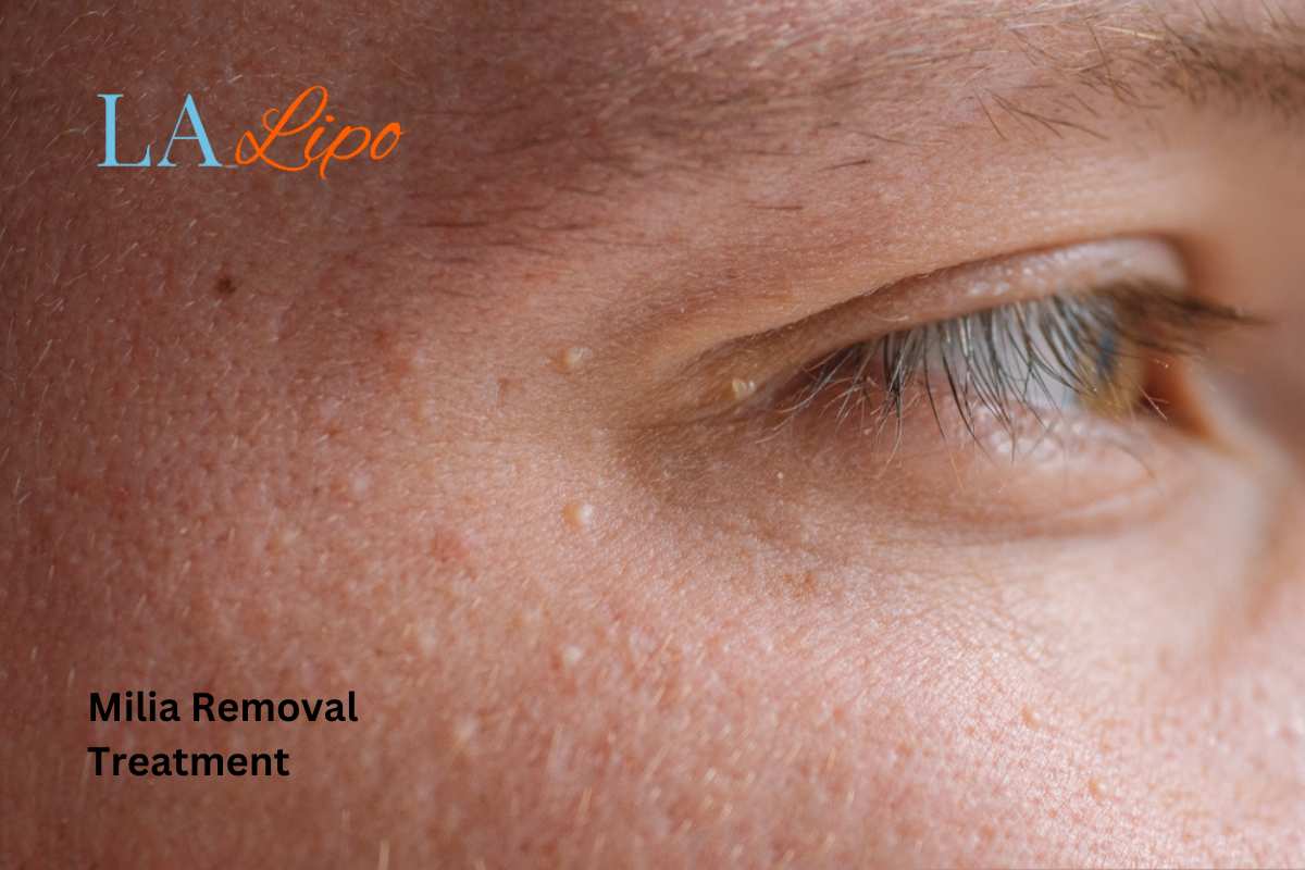 Cryopen Milia Removal: Is It the Easiest and Safest Option Melksham?