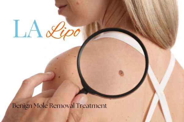 Woman having her inspection of blemish before mole removal Melksham