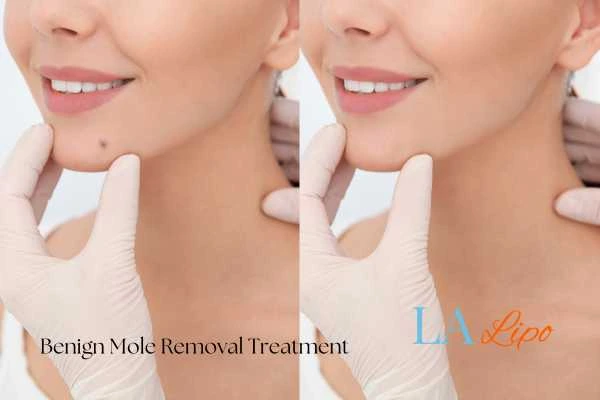 woman's before and after mole removal Melksham results