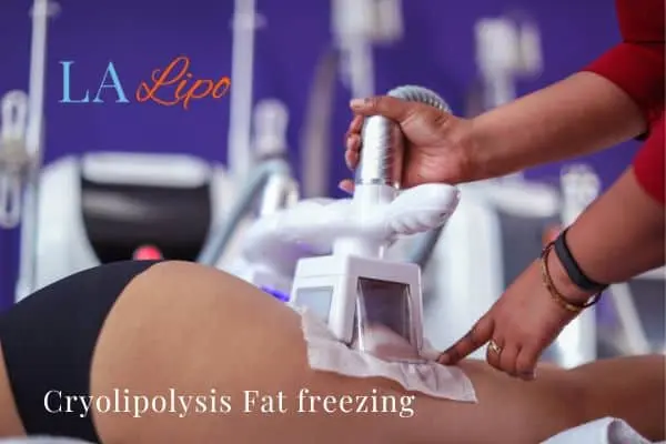 women getting fat freezing Melksham