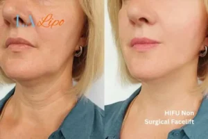 hi-fu for wrinkles Melksham before and after results
