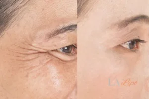 Before and after results of woman - HI-fu wrinkles reduction treatment Melksham