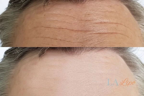 results of HIFU Melksham on mans forehead to help reduce lines and wrinkles