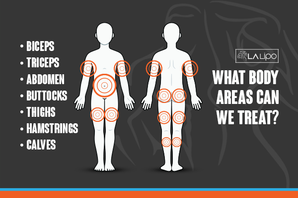 Graphic to show areas you can have LA-EMS Body Sculpting Melksham treatment.