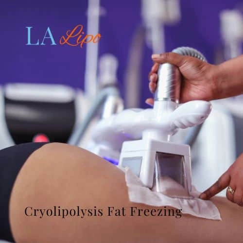 fat freezing - Cryolipolysis Melksham