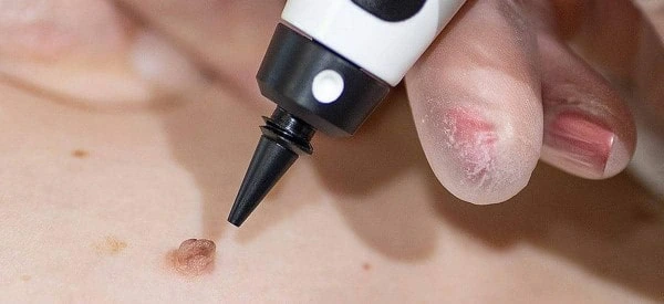 skin tag removal using cryopen Melksham