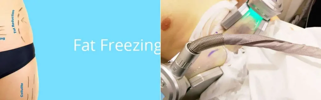 multi areas of a persons body having coolsculpting Melksham treatment