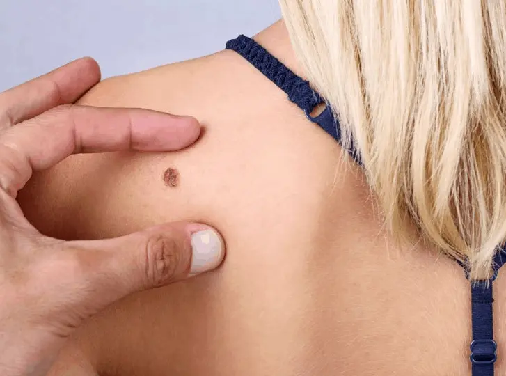 woman having mole removal Melksham consultation before treatment.