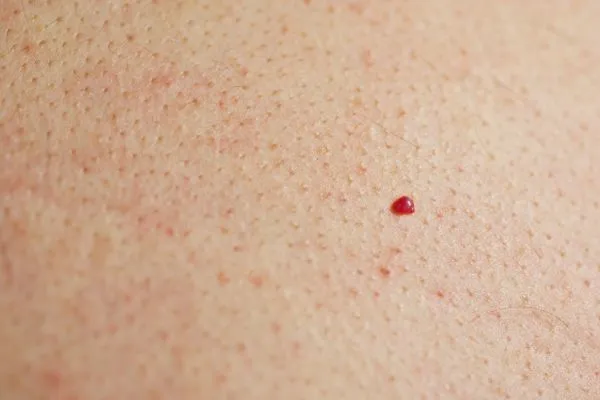 close up of a cherry angioma Melksham