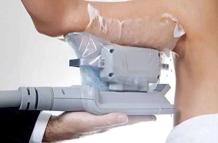 Picture of fat freezing Melksham on the upper arms.