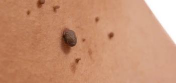 image of a skin tag Melksham