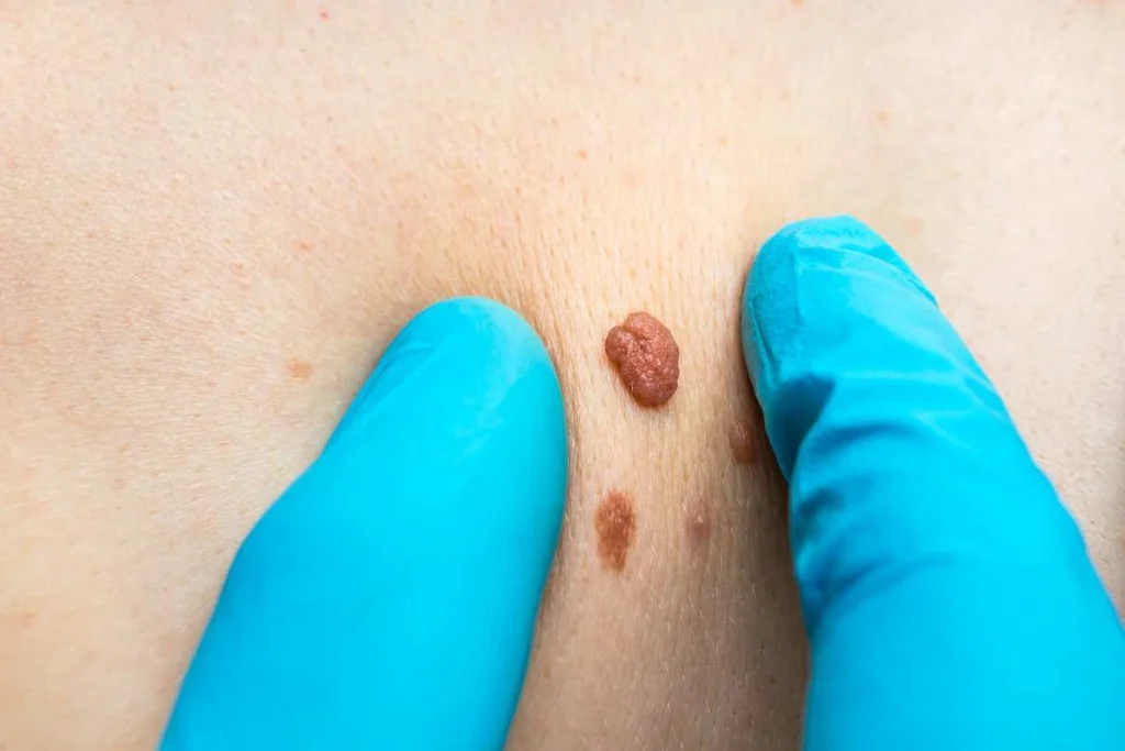 Consultant examining a skin tag Melksham