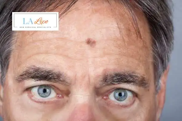 Solar Lentigo Removal Melksham image of man with mark on his forehead