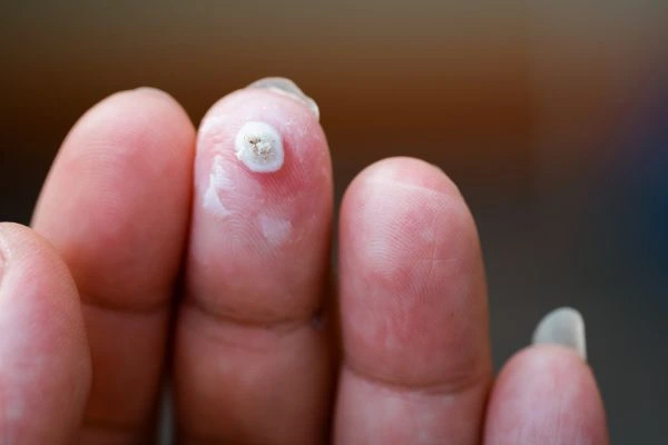 wart on person finger - cryotherapy to treat from LA LIPO Melksham