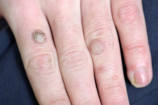 photo of warts on person hand - see wart removal Melksham from LA LIPO