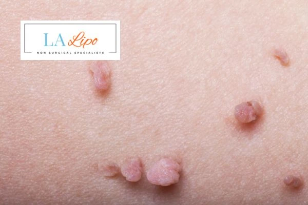 Does cryopen skin tag removal Melksham hurt? Find out now call our team today!