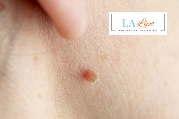 Book skin tag removal Melksham today speak to our team now!