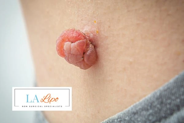 Interested in skin tag removal Melksham? Concerned about the pain? Find out more today!