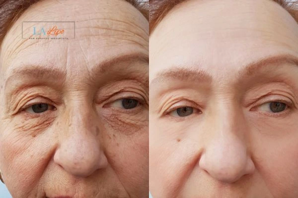 The powerful benefits of Morpheus8 Treatment Melksham - Call Our team today!
