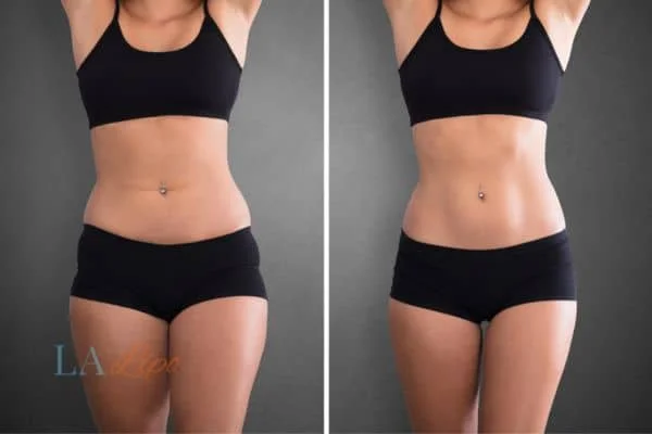 before and after results of non-surgical treatment to help a woman's body image and mental health Melksham