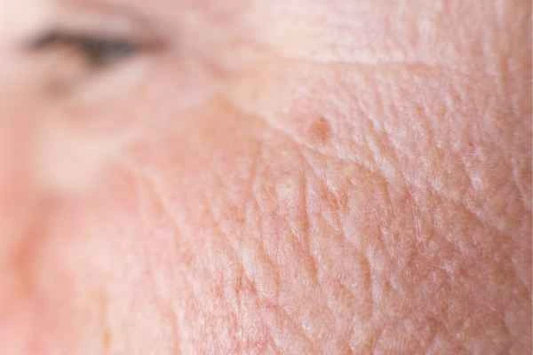 close up picture of a woman's face showing an age spot Melksham