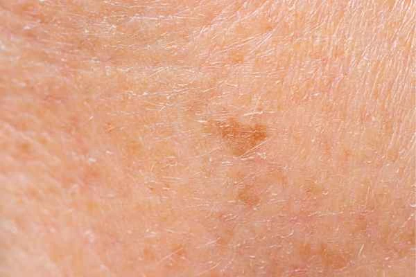 close up picture of age spots Melksham