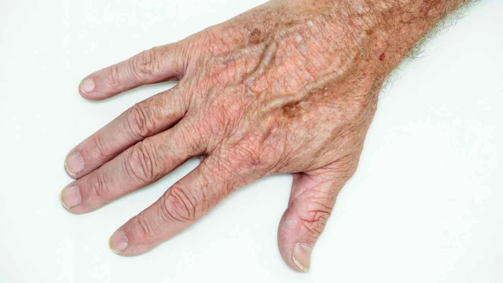 Male hand showing age spot Melksham