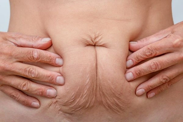 Image of a woman's stomach with loose skin - example of skin tightening Melksham options