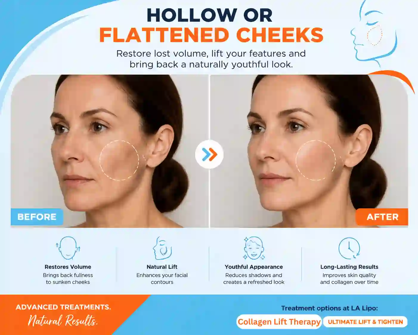 Sign #4: Hollow or Flattened Cheeks Melksham