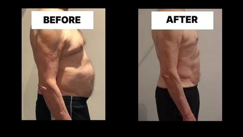 What Symptoms Can Diastasis Recti Cause in Men? Weak Core, Back Pain and Poor Posture Melksham